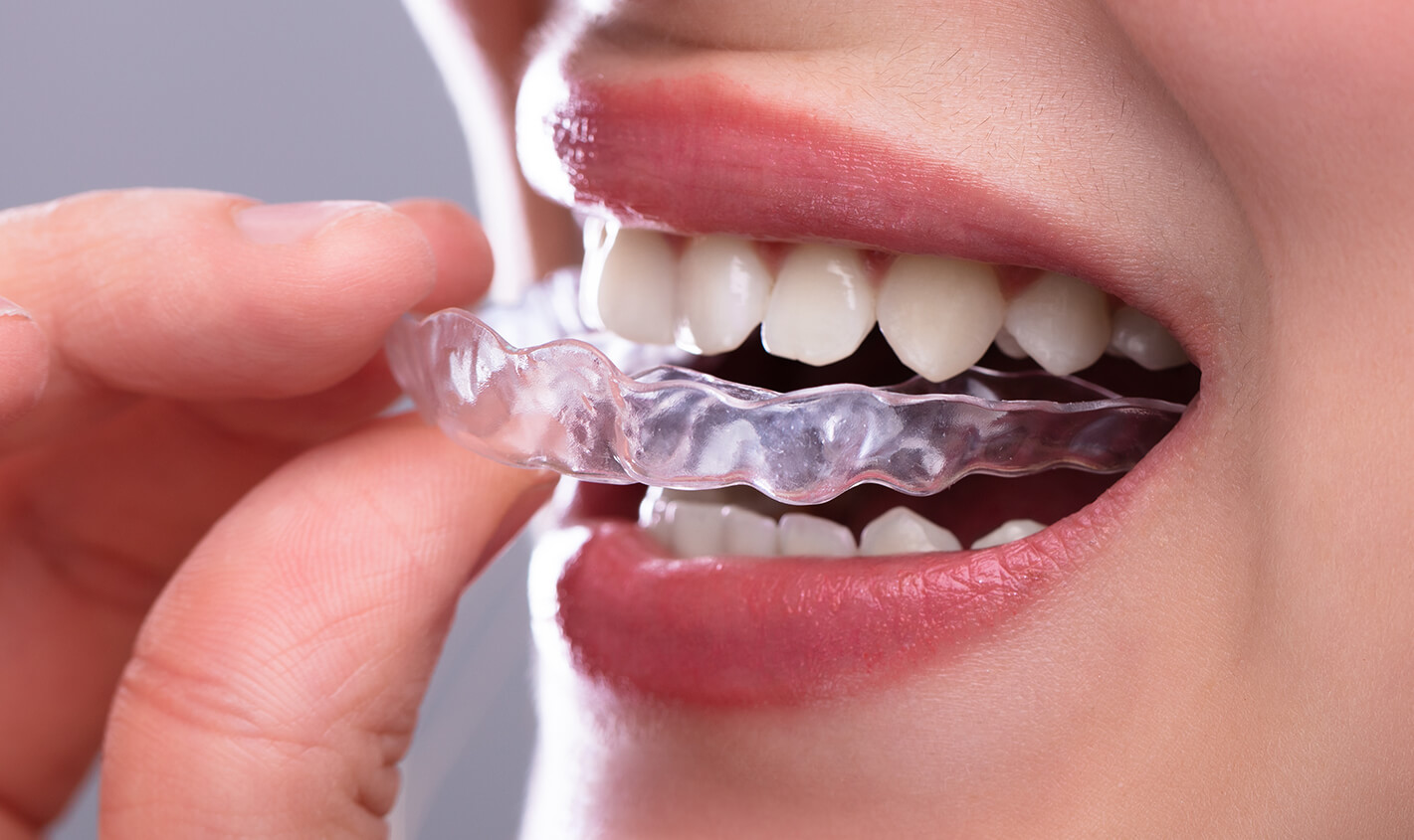 What You Should Know About Invisalign Before Committing Yourself to The Treatment