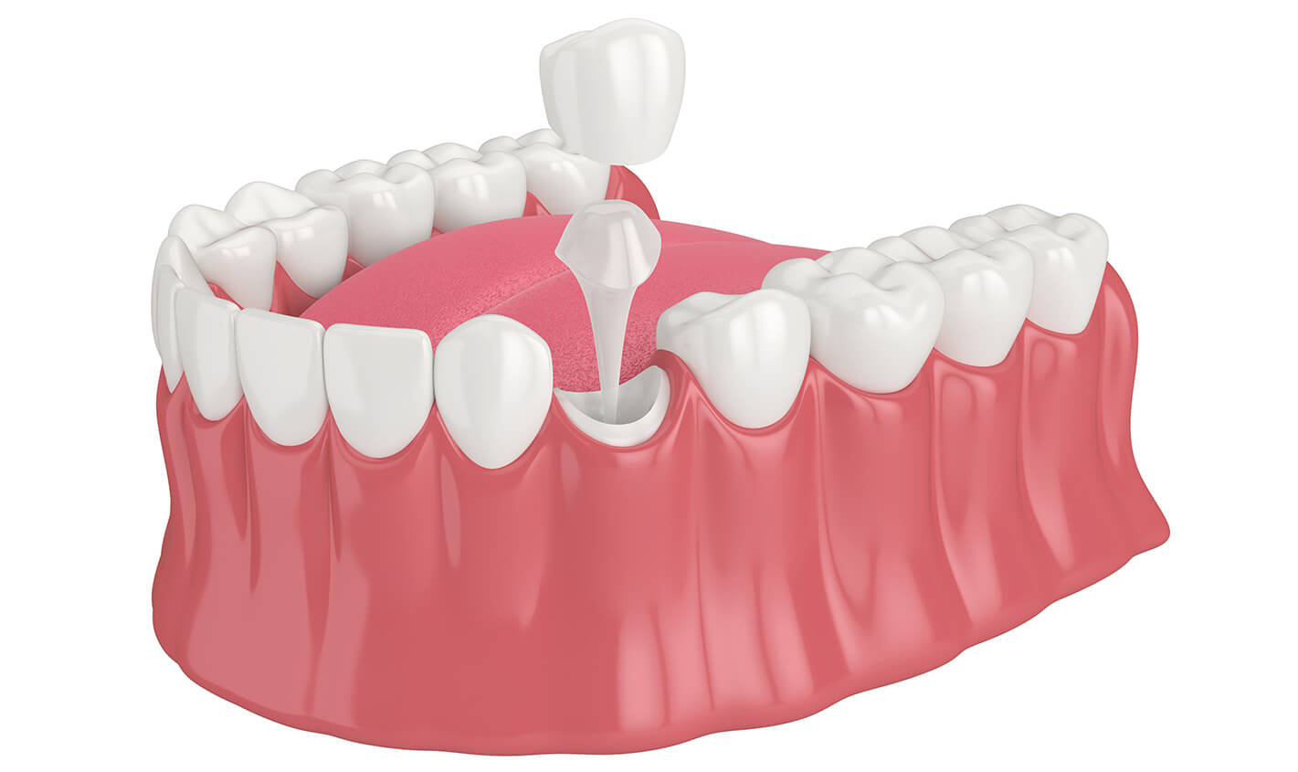 Dental Crown Replacement in Tucson AZ Area