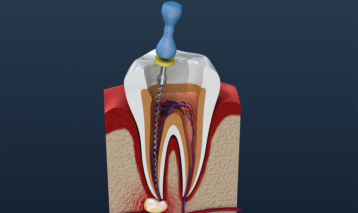 Is Root Canal Treatment Painful in Tucson AZ Area